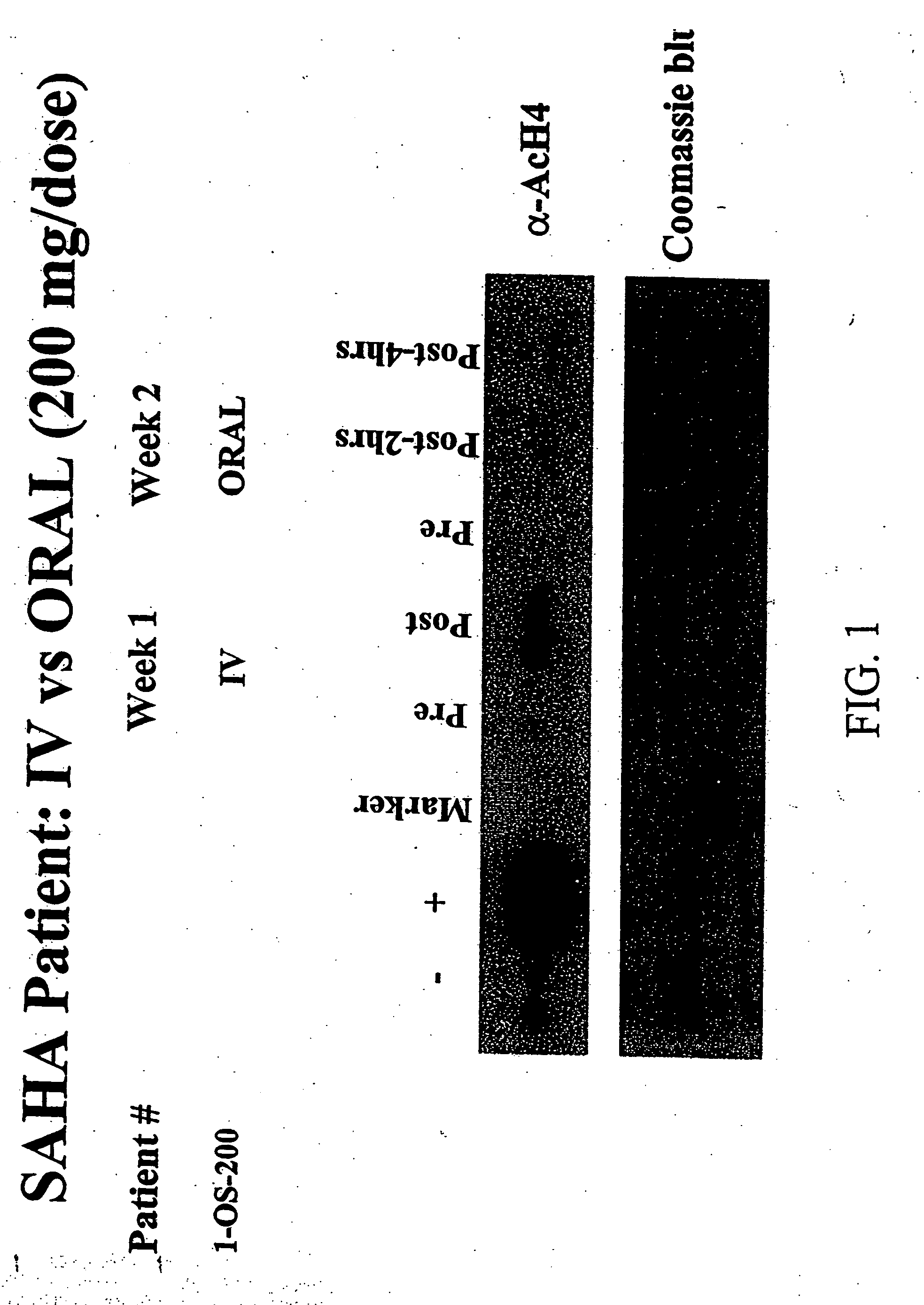 Methods of treating cancer with HDAC inhibitors