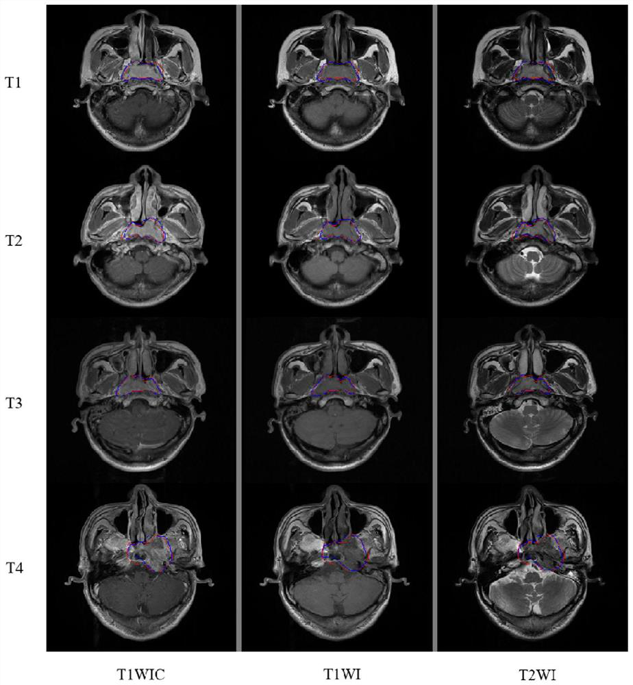 Nasopharyngeal carcinoma identification and tumor segmentation method and system based on MR image