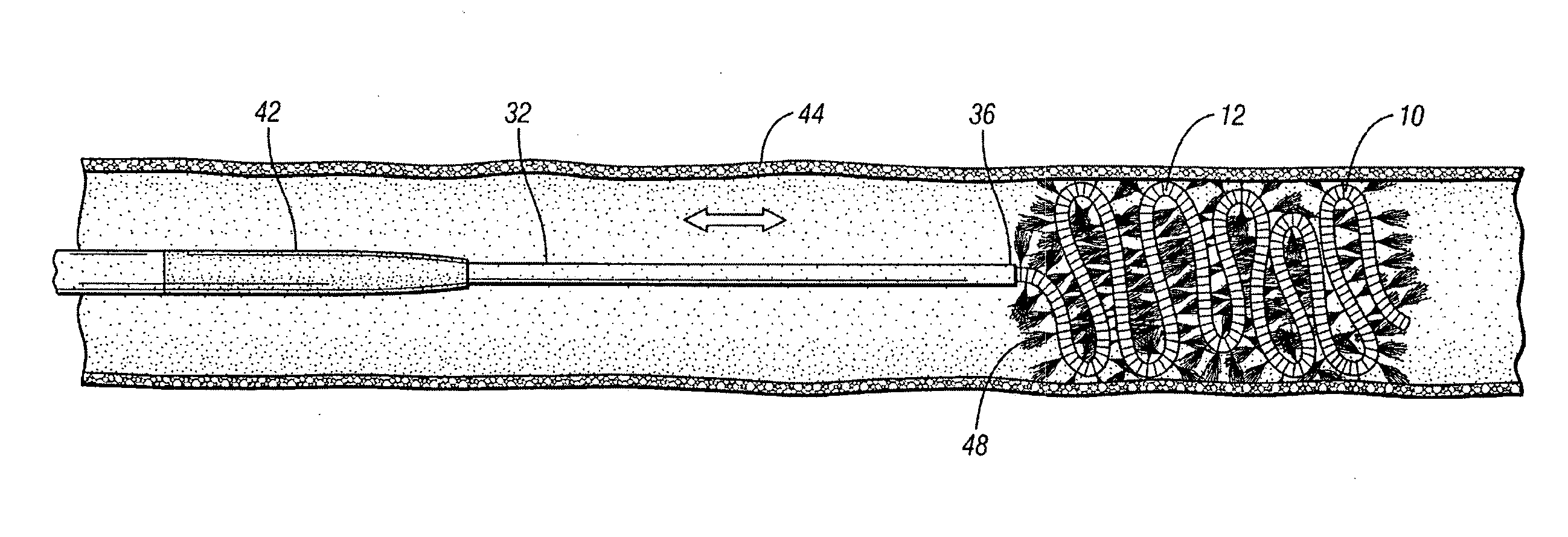 Occluding device for occlusion of a body vessel and method for making the same