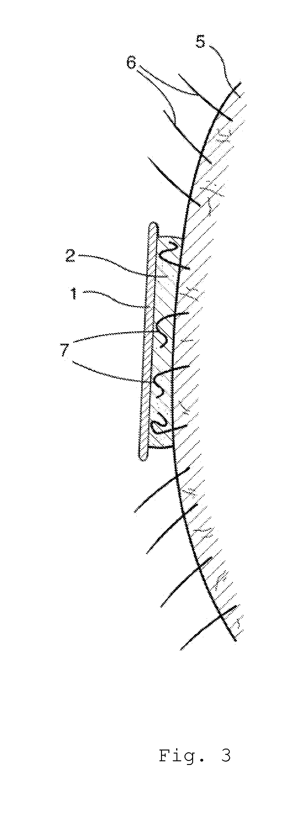 Tensionable Depilatory Article