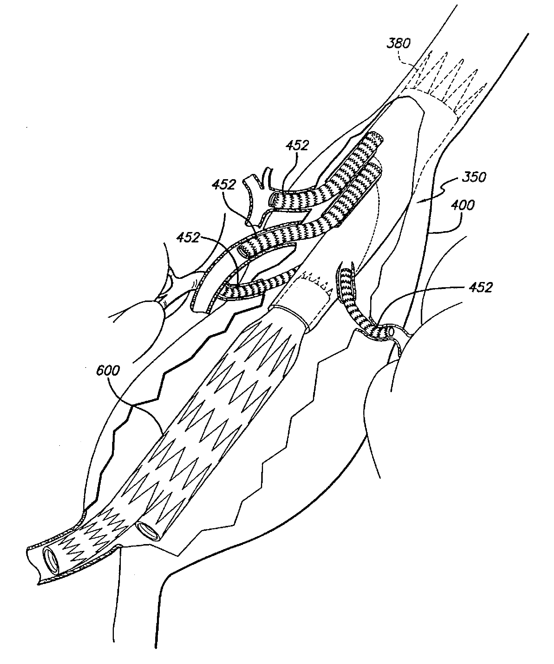 Modular grafting system and method