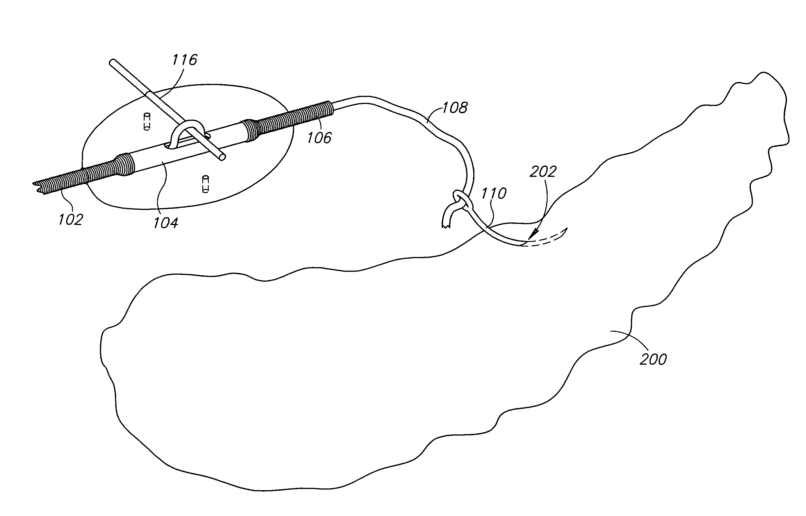 Pancreas lead