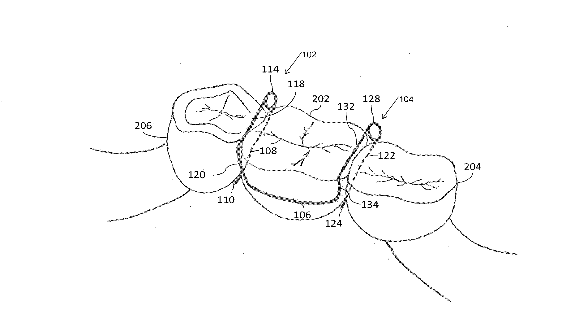 Orthodontic separator