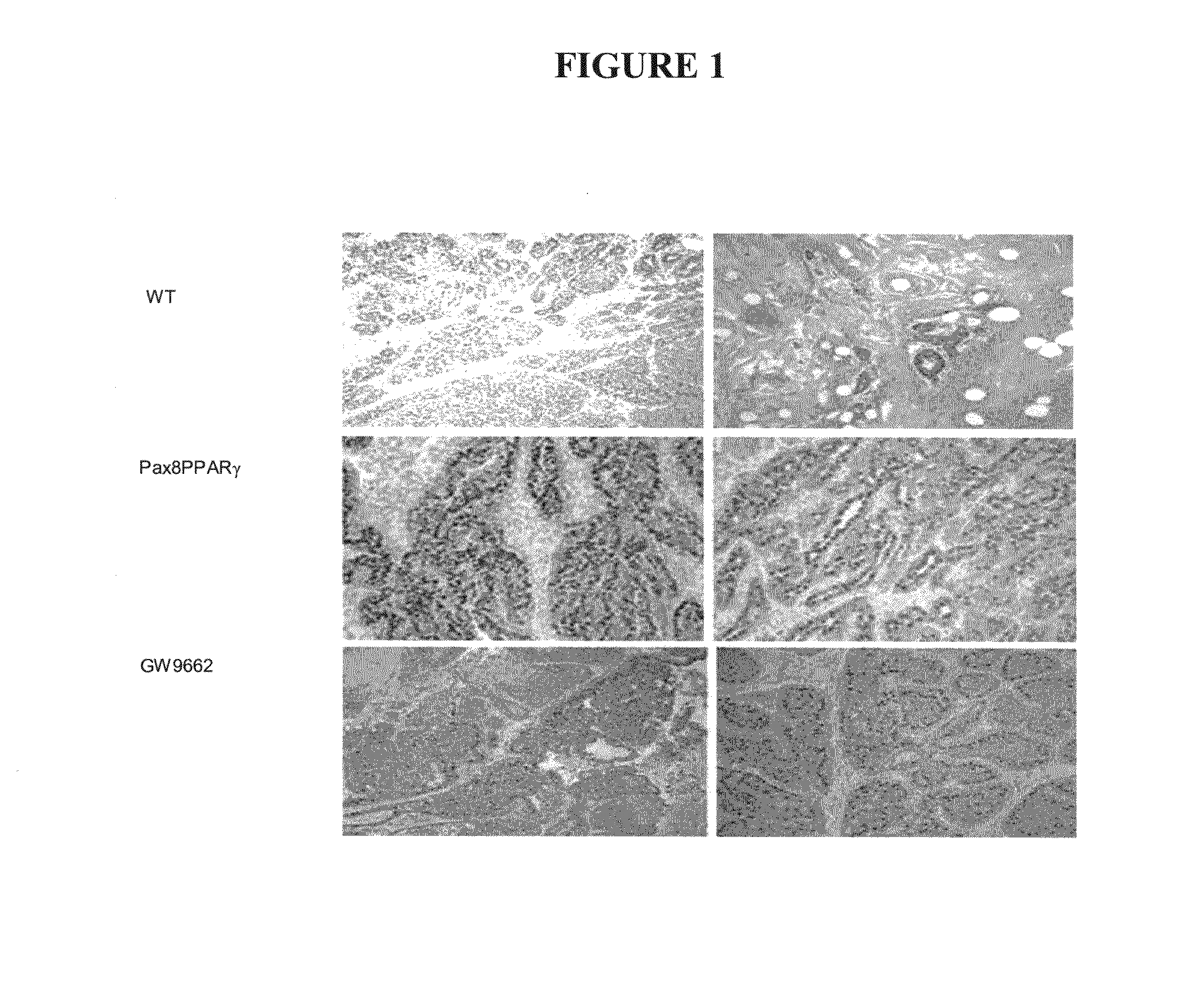 Method for the treatment of breast cancer