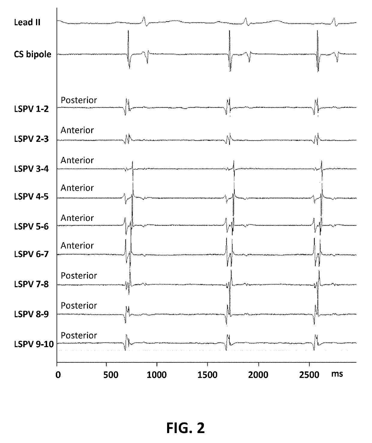 Detection of pulmonary vein isolation