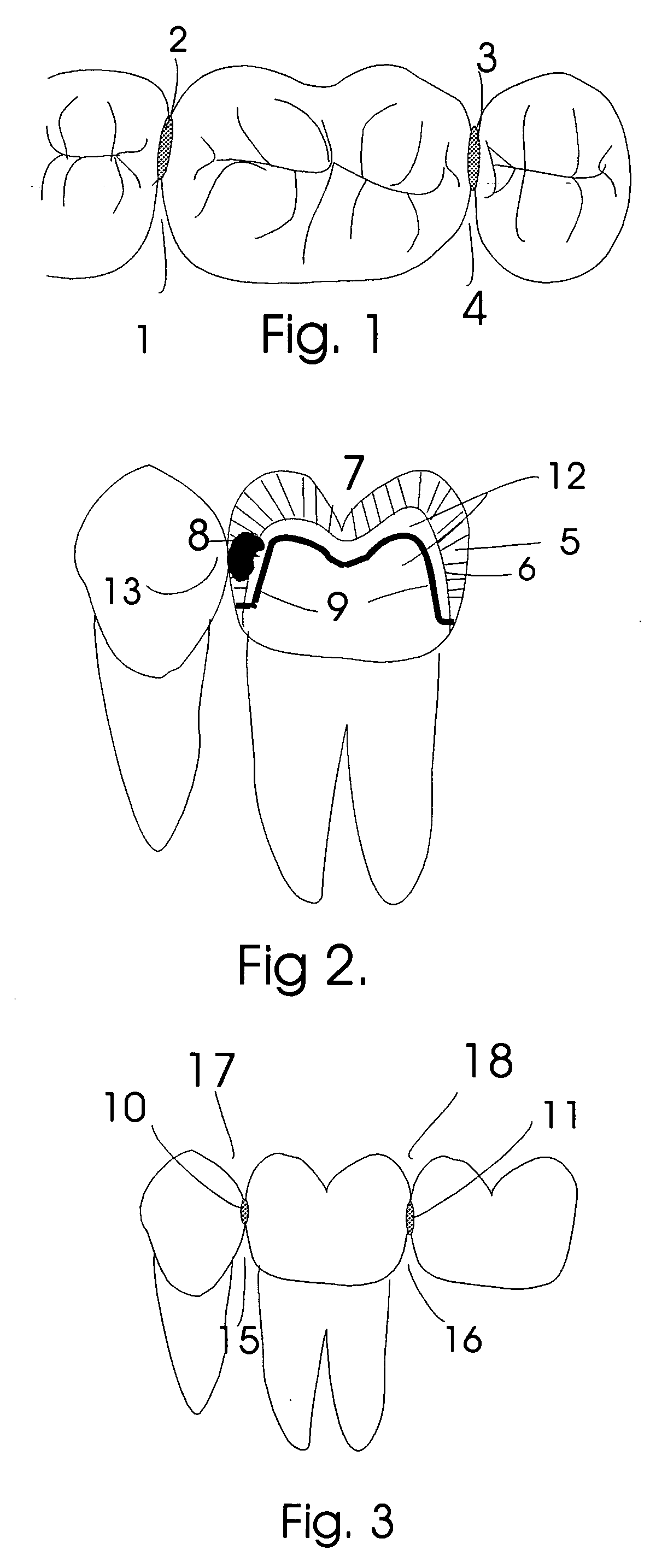 Dental insert and method of tooth restoration