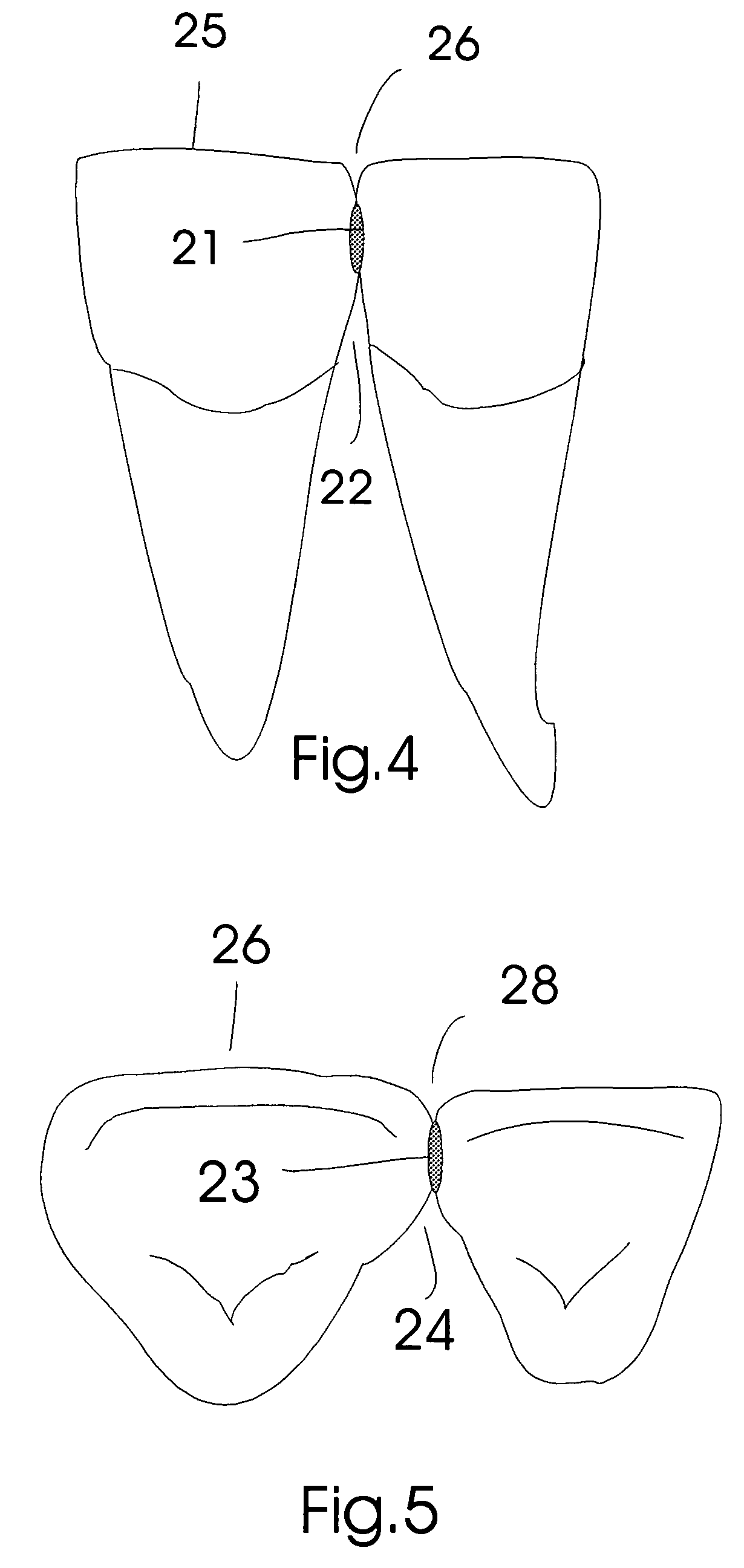 Dental insert and method of tooth restoration