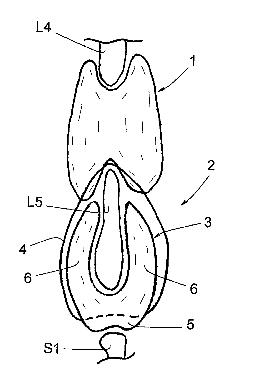 Interspinous spinal prosthesis