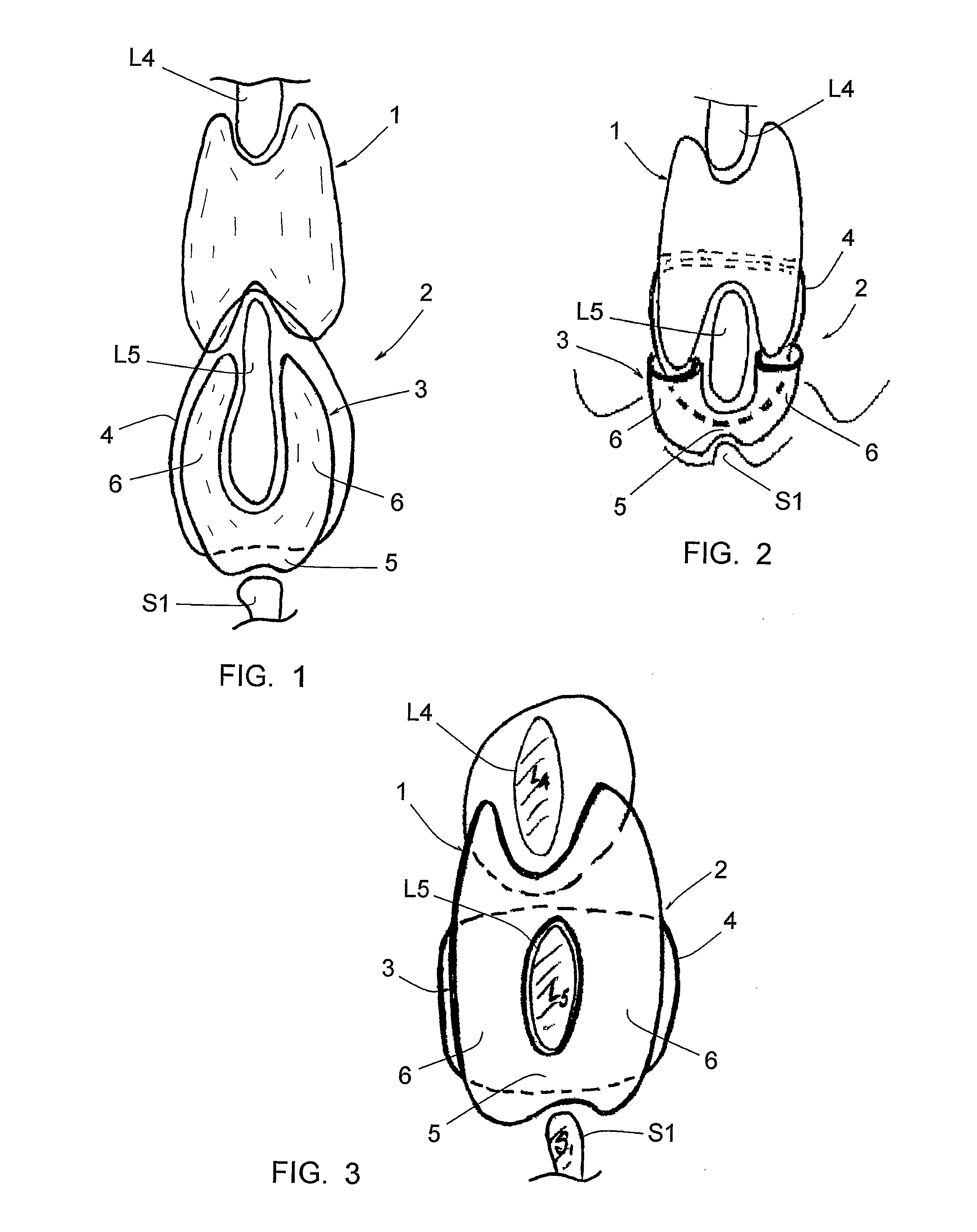 Interspinous spinal prosthesis