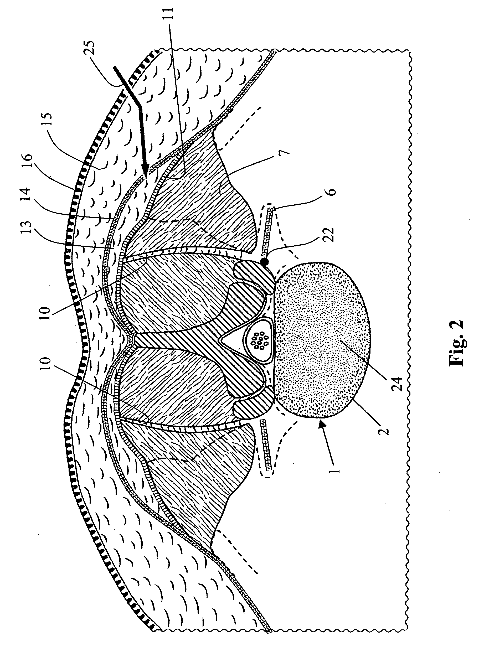 Method for repair of a spine and intervertebral implant