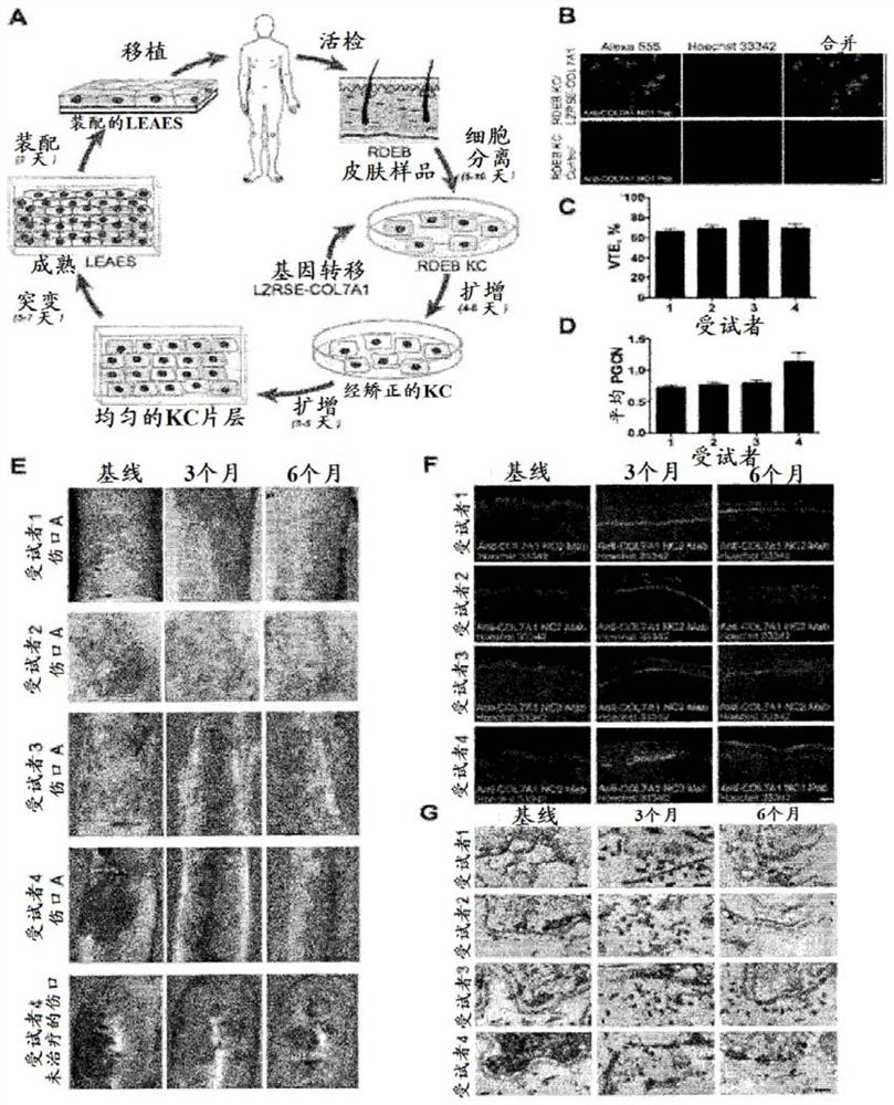 Gene therapy for recessive dystrophy epidermis bullosa using genetically corrected autologous keratinocytes