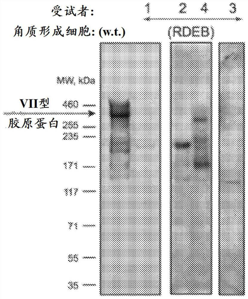 Gene therapy for recessive dystrophy epidermis bullosa using genetically corrected autologous keratinocytes