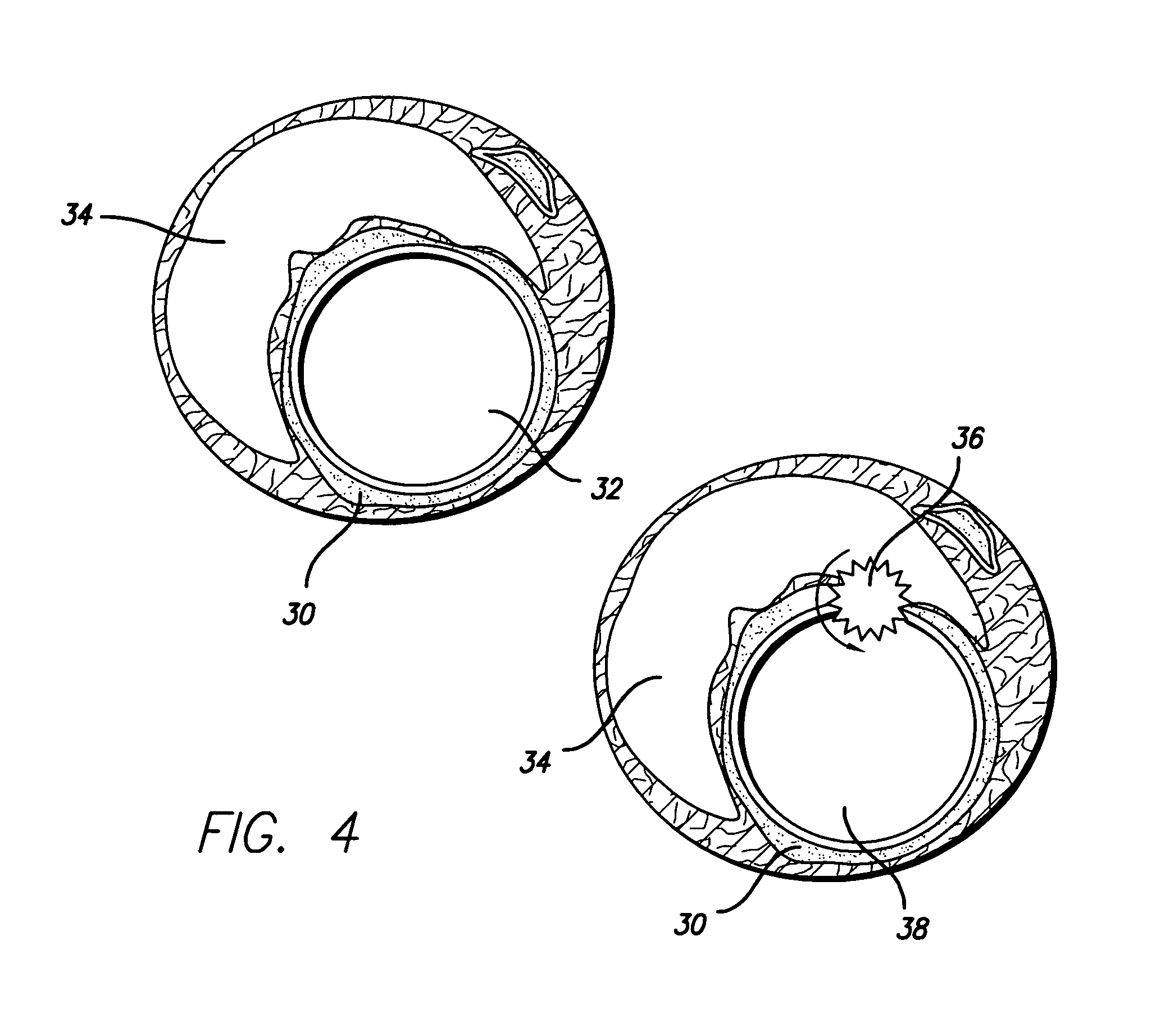 Stent for treating vulnerable plaque