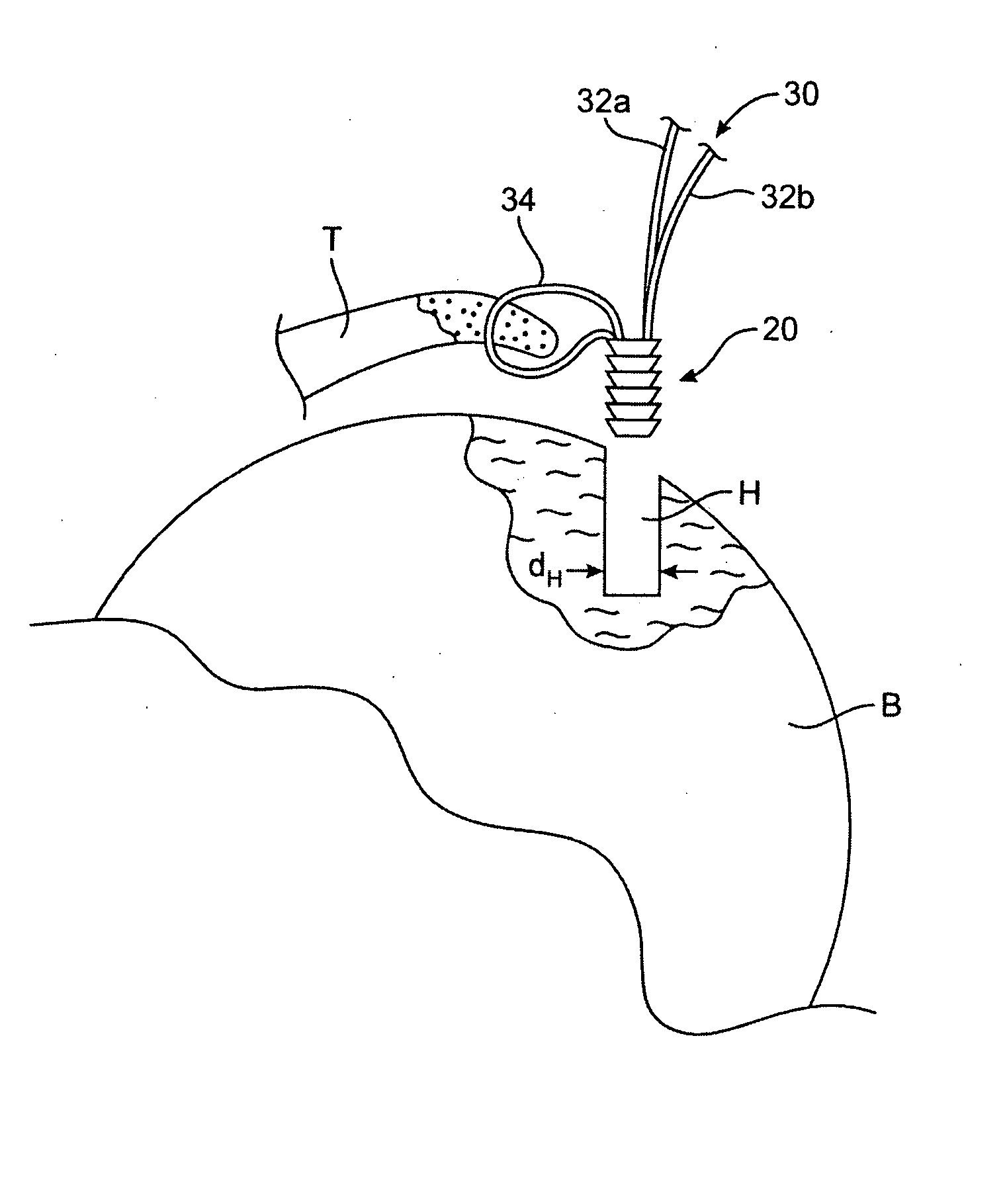 Suture passer devices and uses thereof