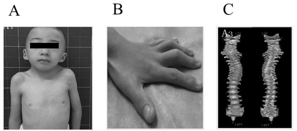 Diagnosis of gene mutation of cvm and its application