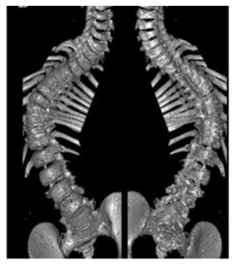 Diagnosis of gene mutation of cvm and its application