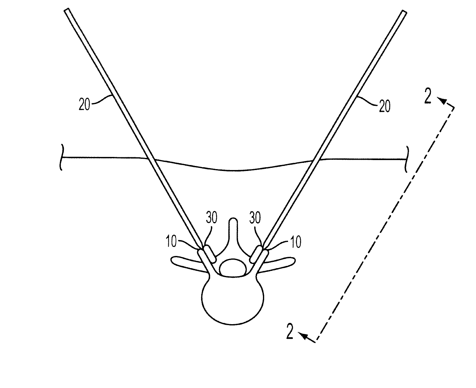 Methods and surgical kits for minimally-invasive facet joint fusion