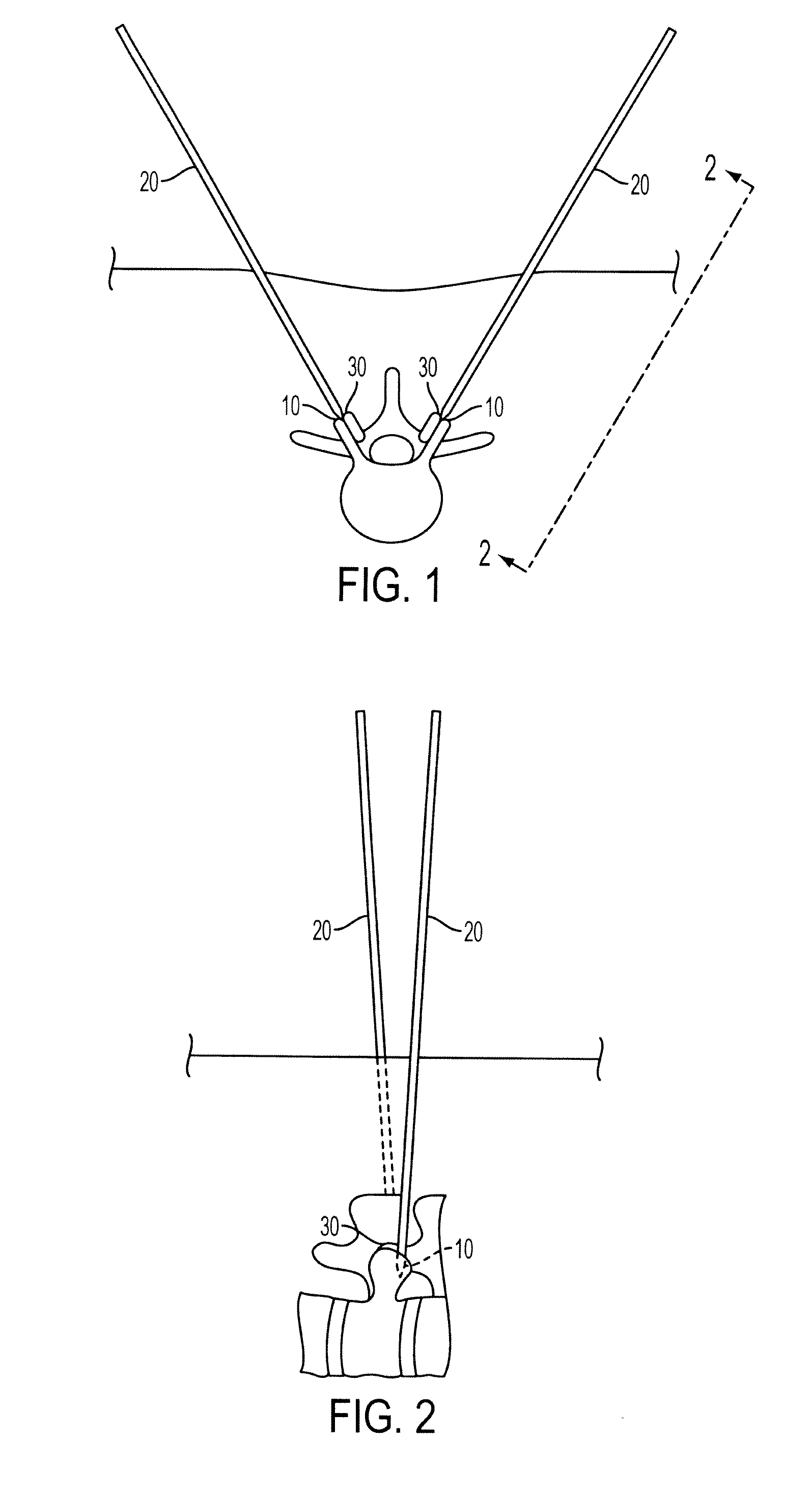 Methods and surgical kits for minimally-invasive facet joint fusion