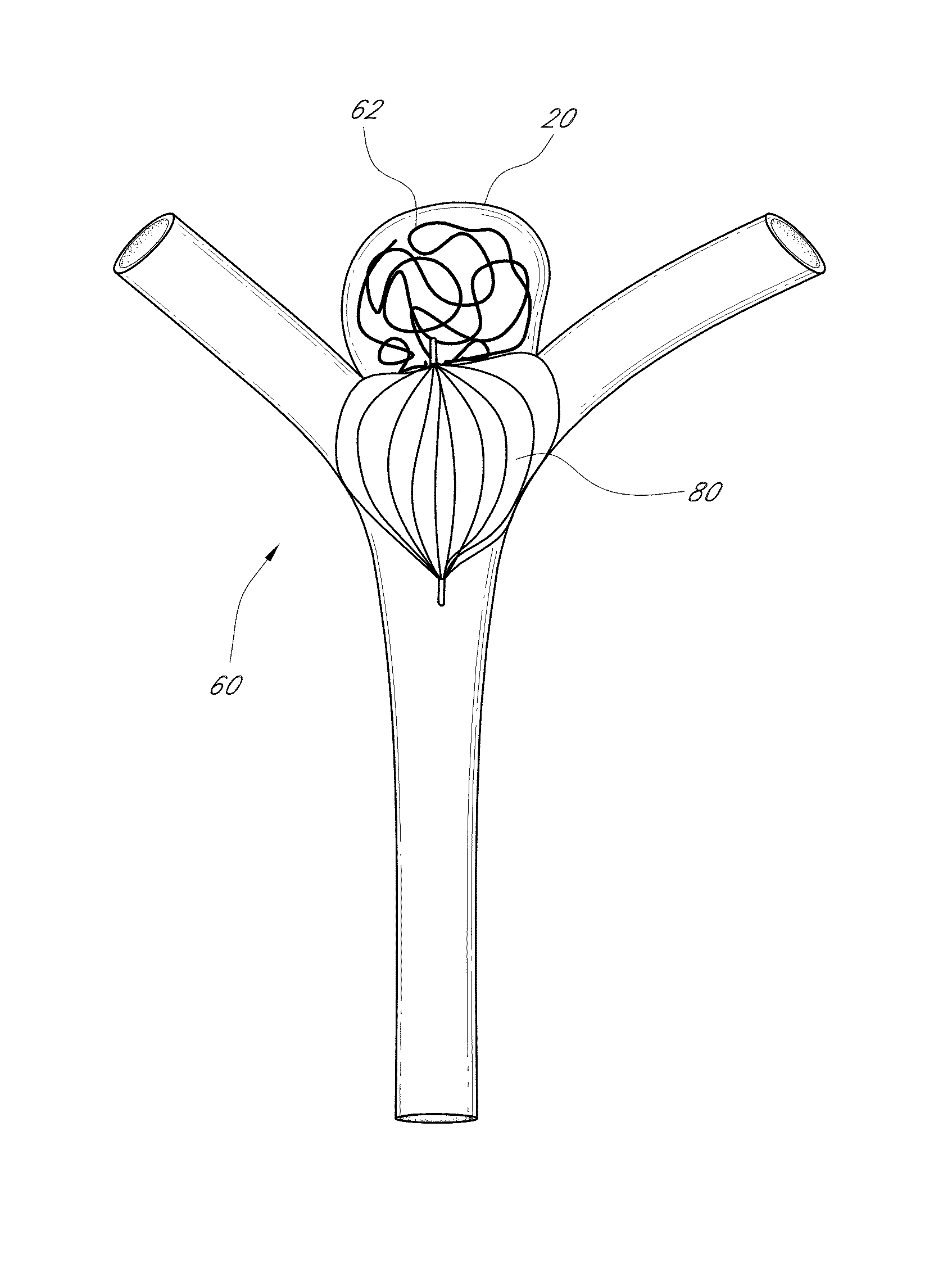 Vascular remodeling device