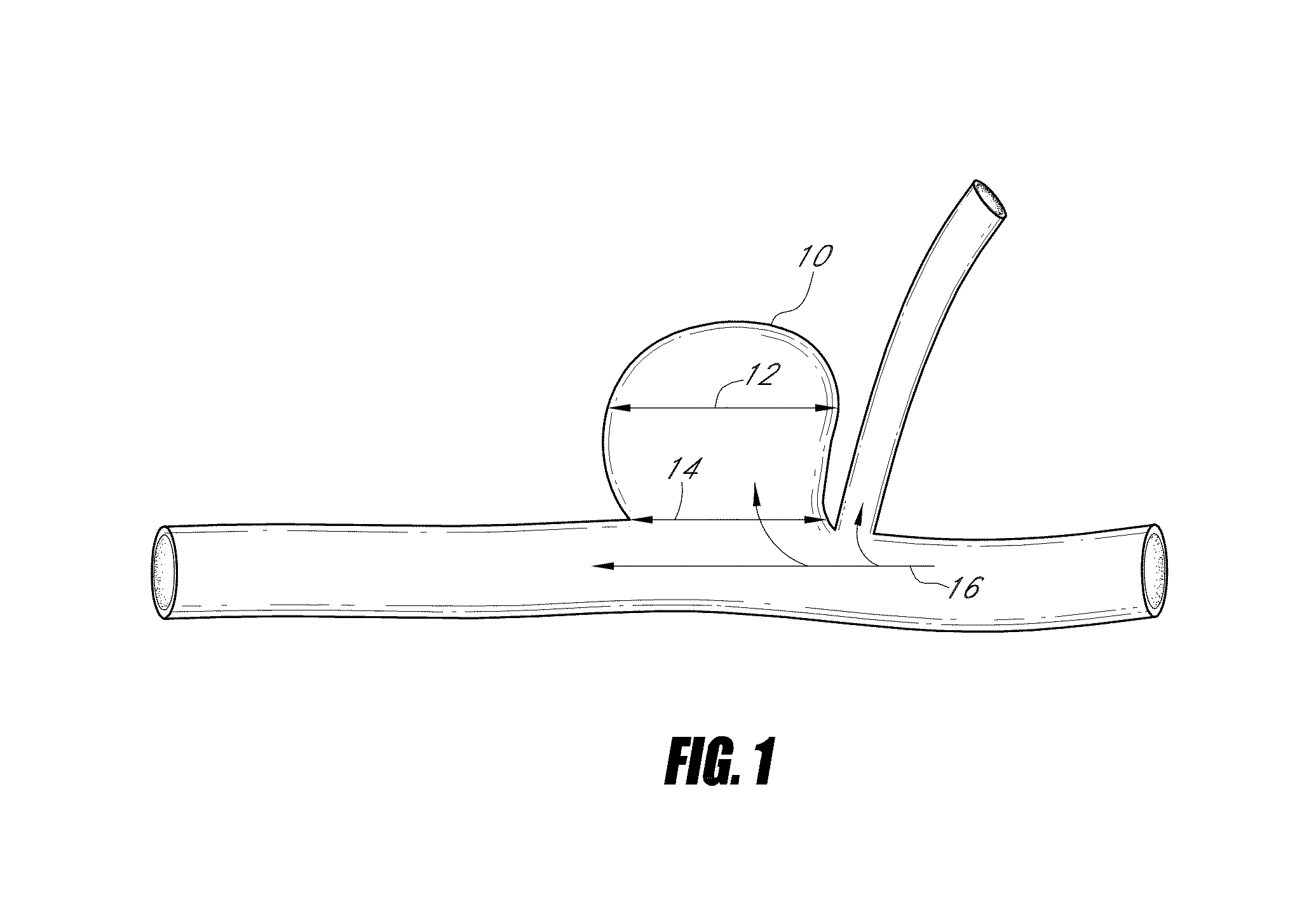 Vascular remodeling device