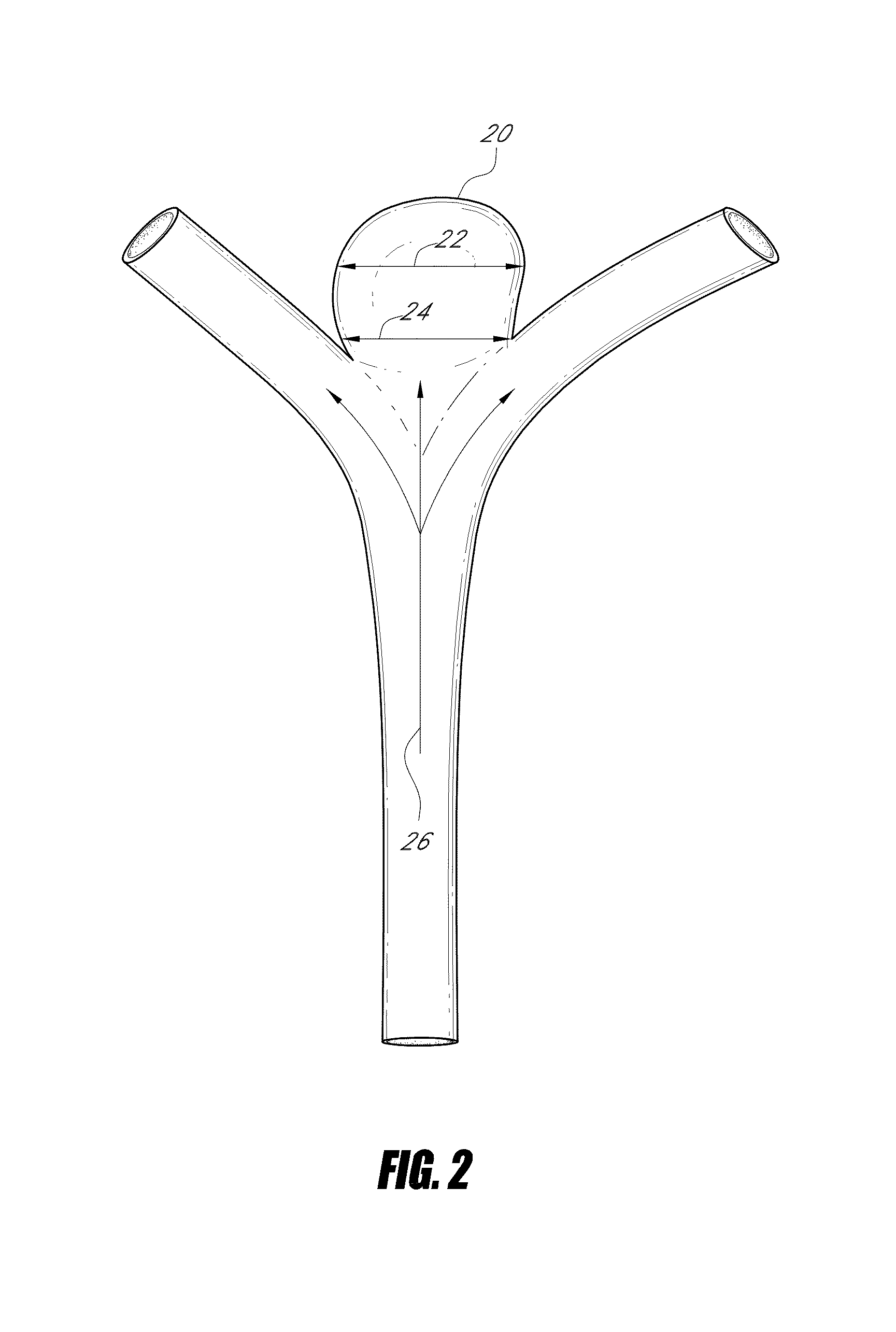 Vascular remodeling device