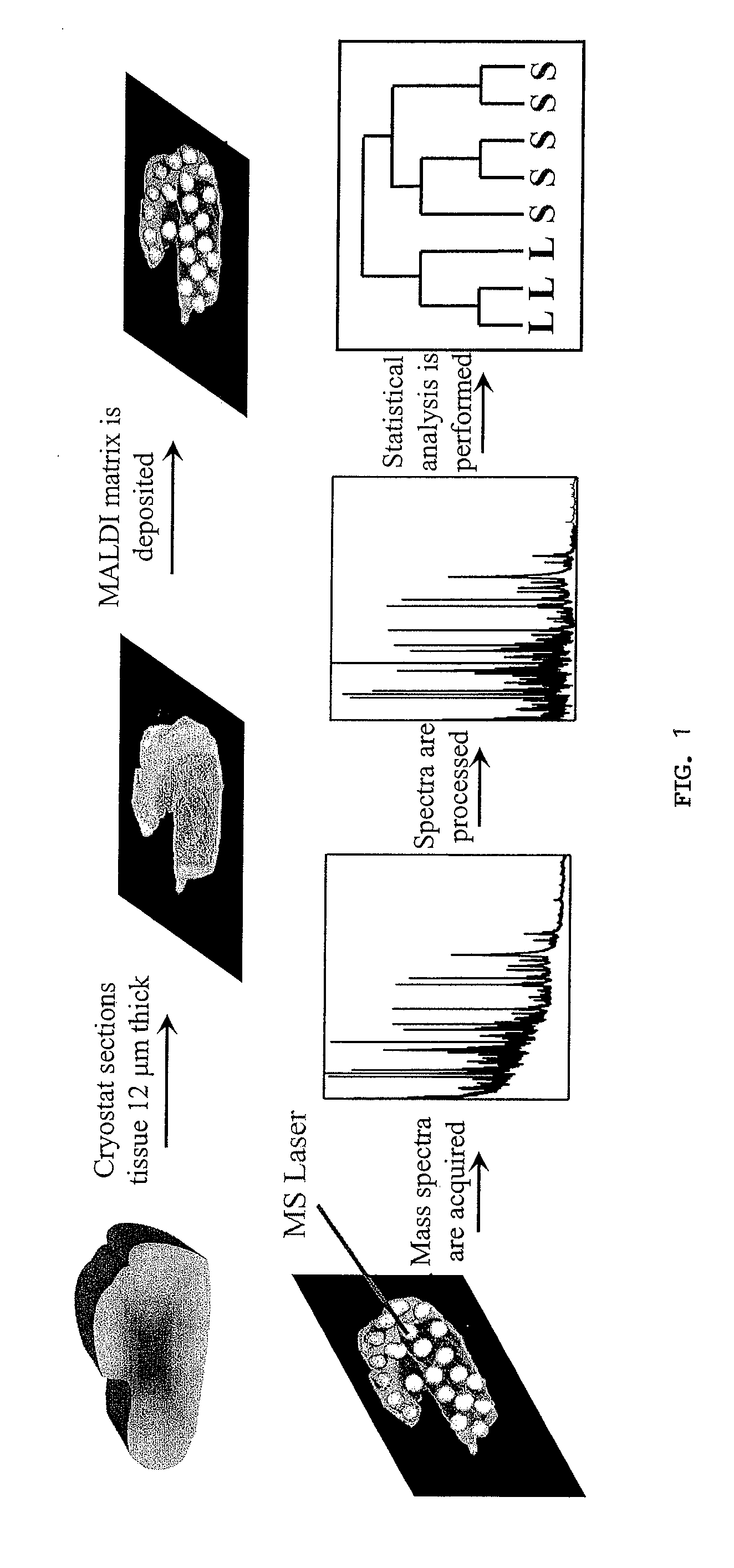 Diagnosing and Grading Gliomas Using a Proteomics Approach