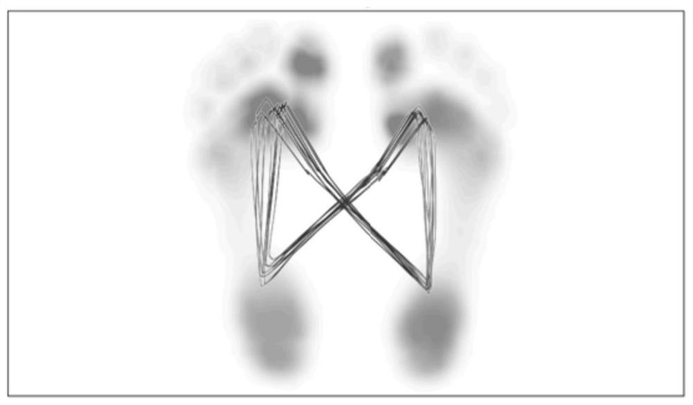 A method for evaluating gait patterns in patients with unilateral Achilles tendon rupture during rehabilitation