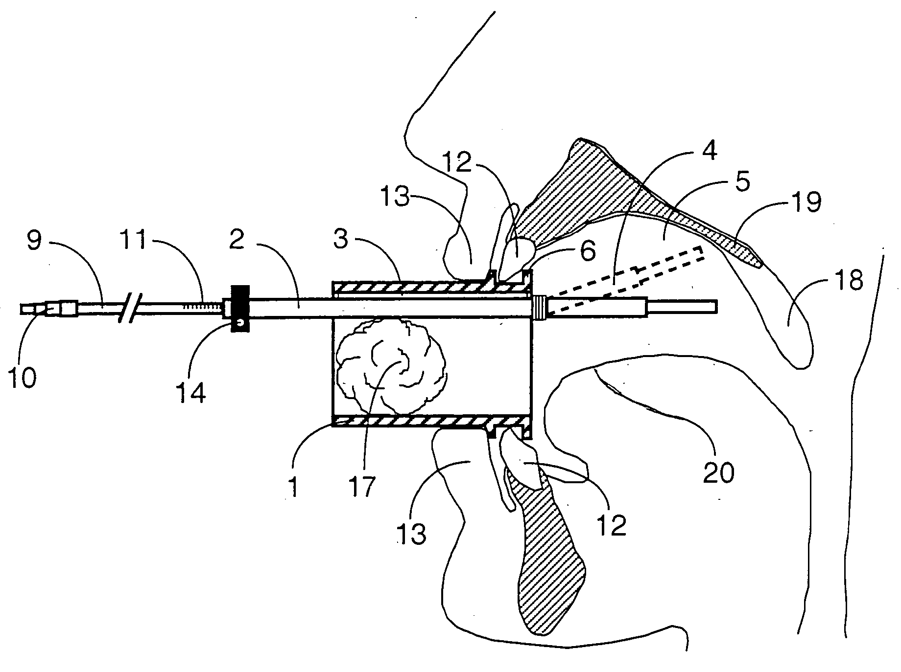 Mouthpeice intended for a device used to assess the sensitivity of the pharynx and a device comprising same