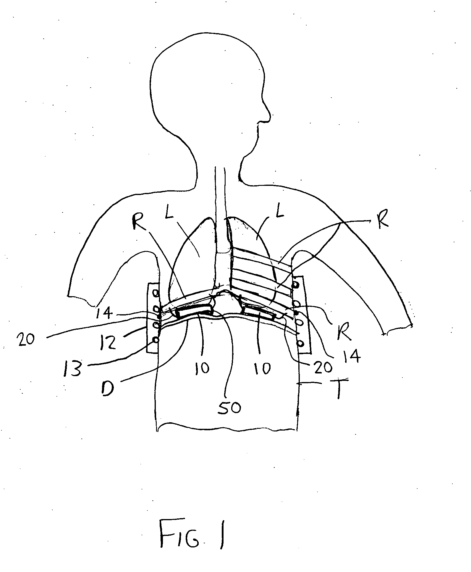 Electromagnetic diaphragm assist device and method for assisting a diaphragm function