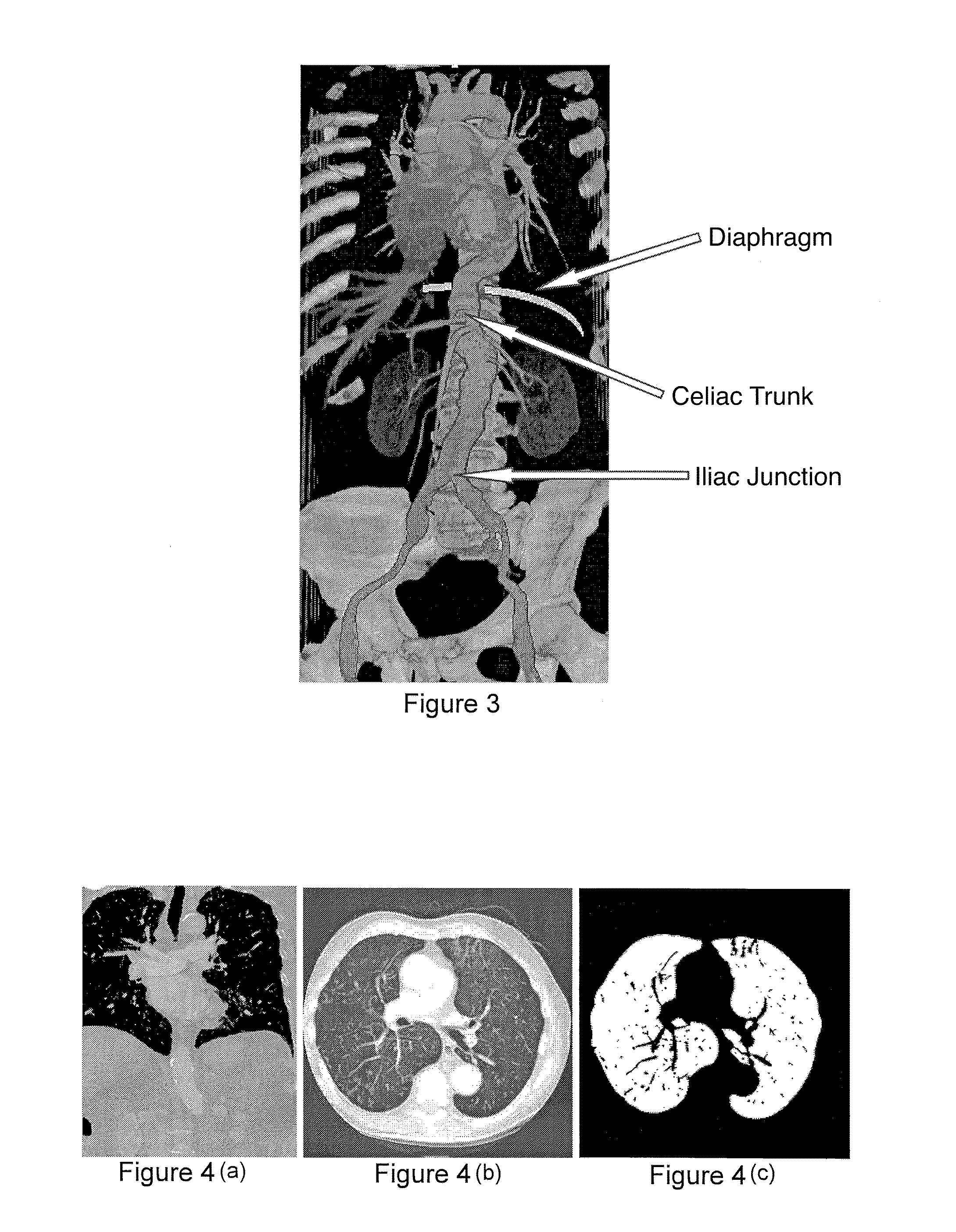 Automatic detection and accurate segmentation of abdominal aortic aneurysm