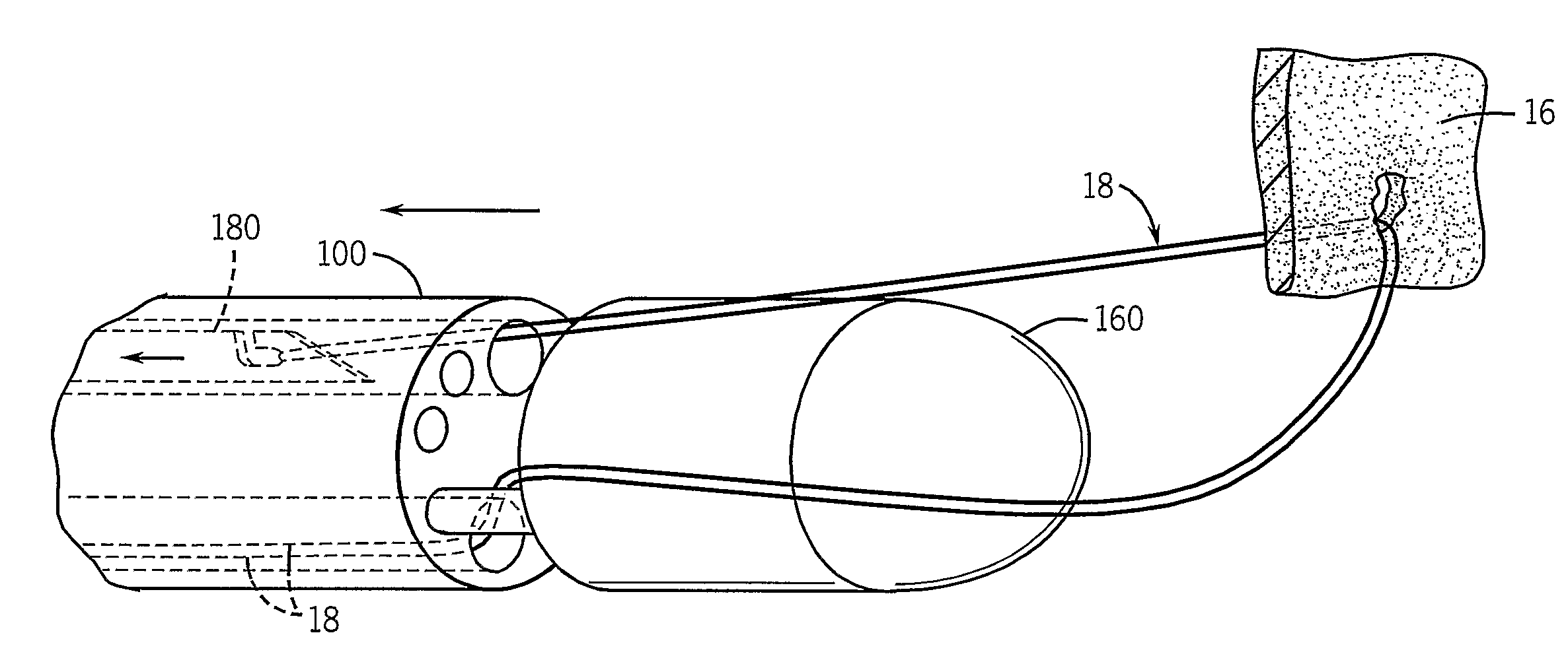 Thorascopic Heart Valve Repair Method and Apparatus