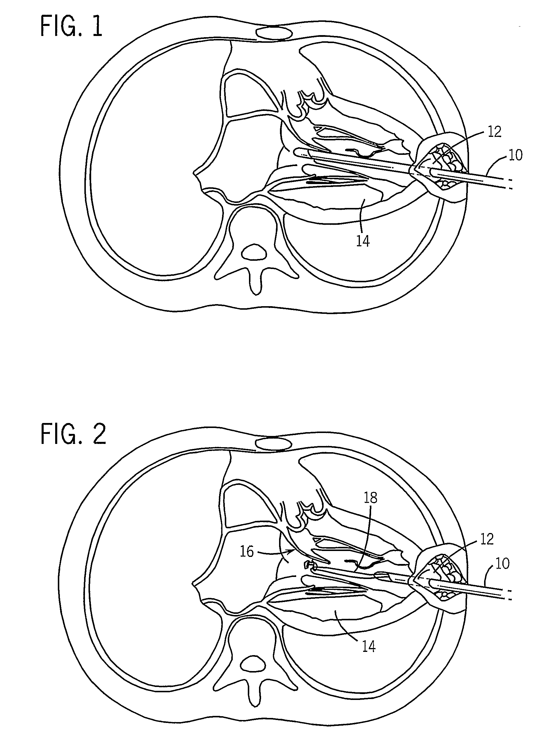 Thorascopic Heart Valve Repair Method and Apparatus