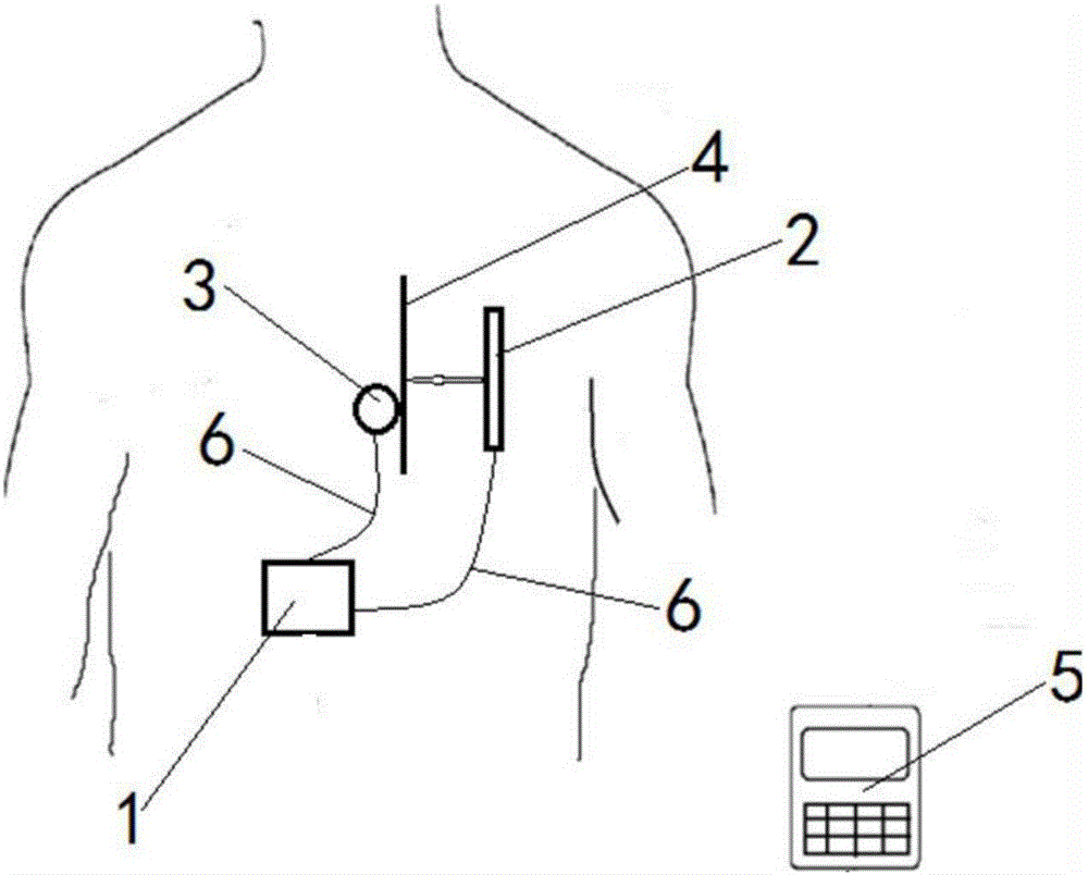 Implantable sacral nerve stimulator with electrode dislocation prompting function