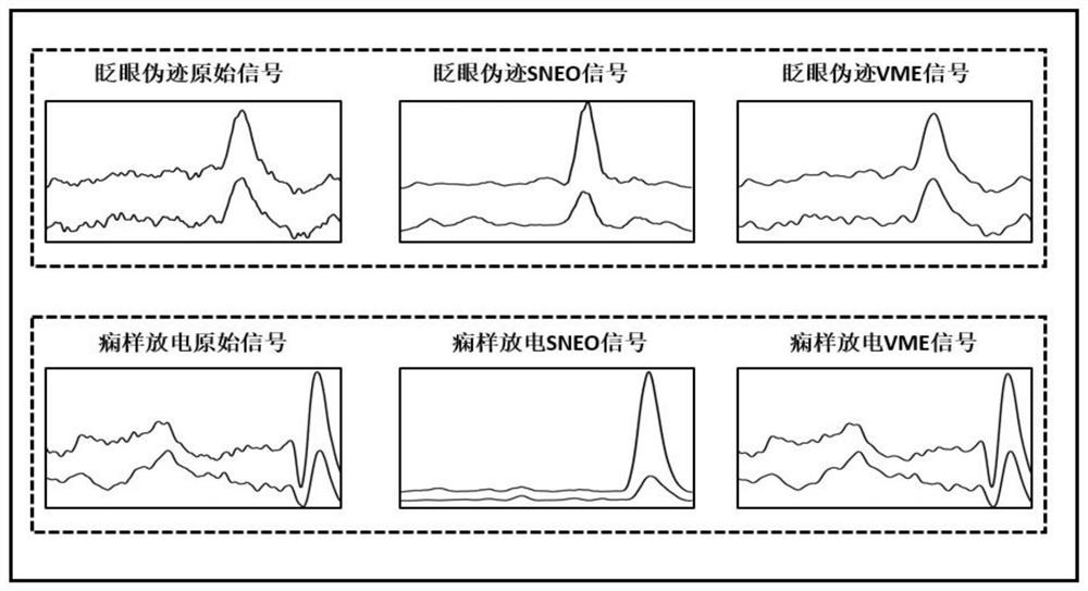 Intelligent classification method for distinguishing electroencephalogram blink artifacts and frontal electrode epilepsy discharge