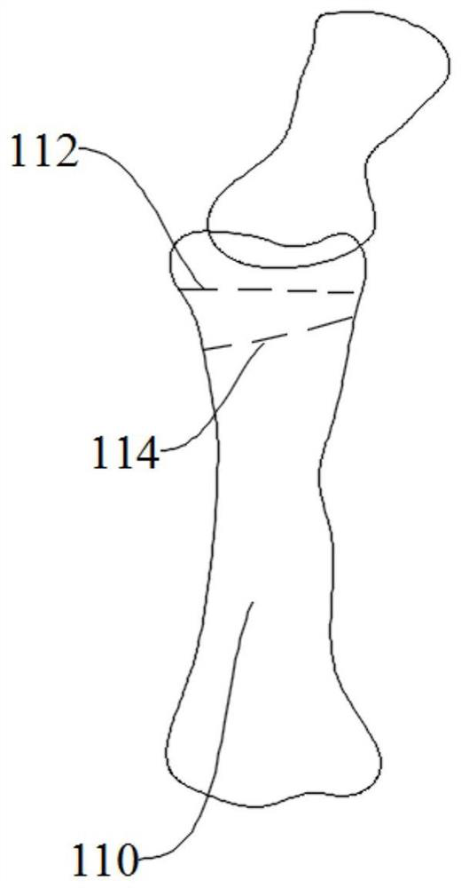 A kind of osteotomy orthopedic guide plate and its manufacturing method