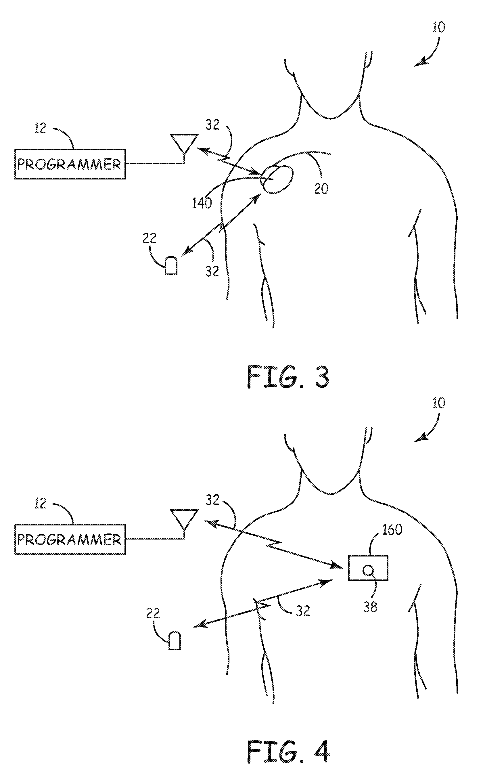 System and method for monitoring or treating nervous system disorders