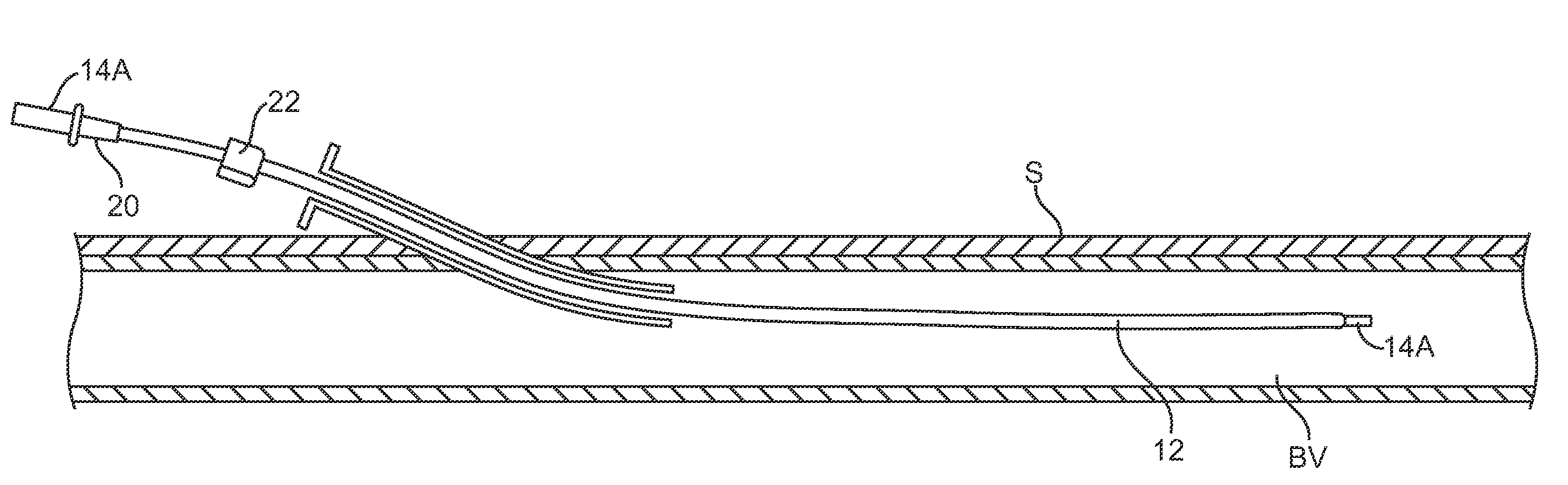 Vascular sheaths and methods for their deployment