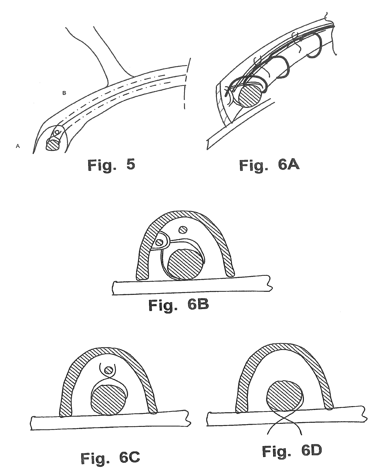 Delivery Device for Medical Implant and Medical Procedure