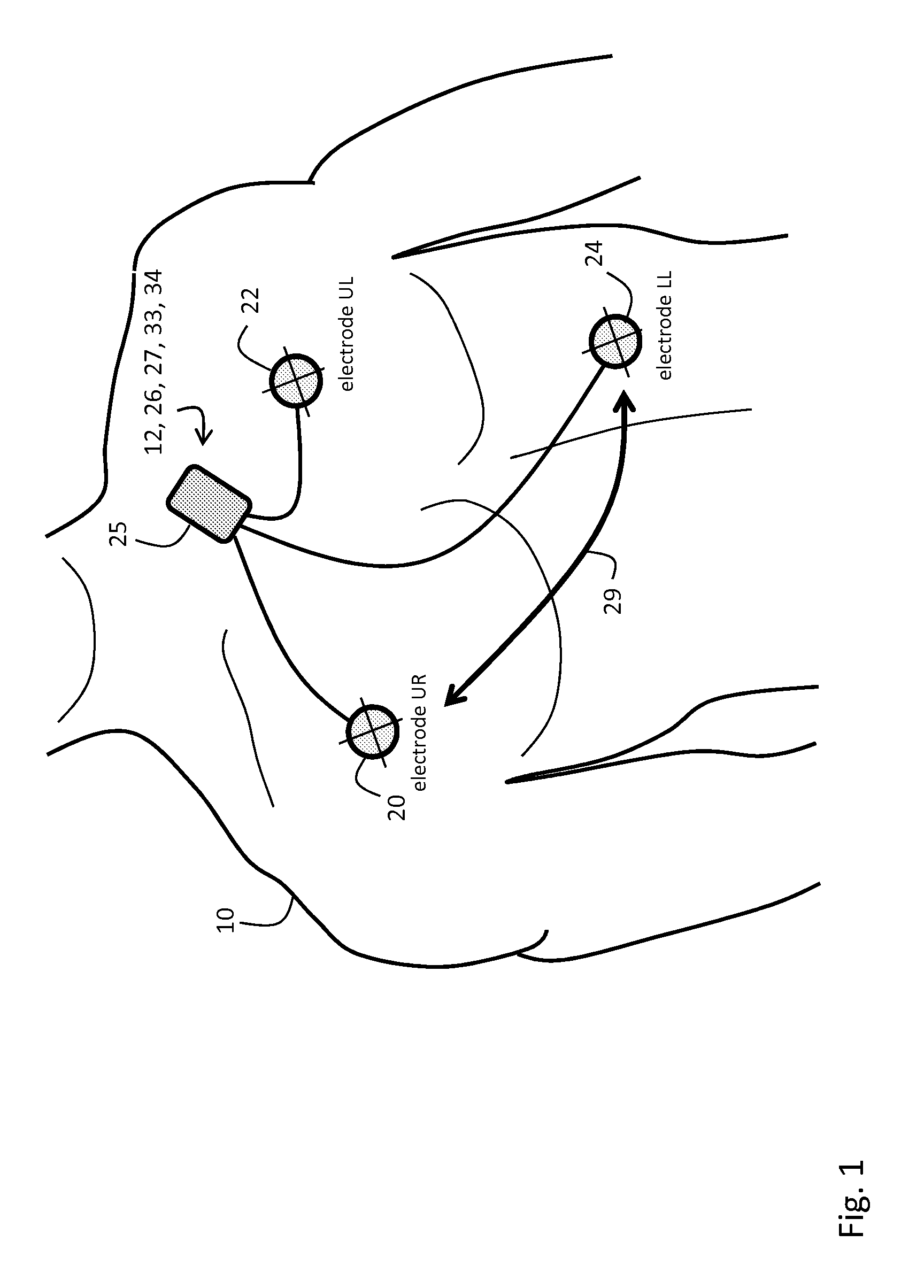 Body-worn monitor for measuring respiratory rate