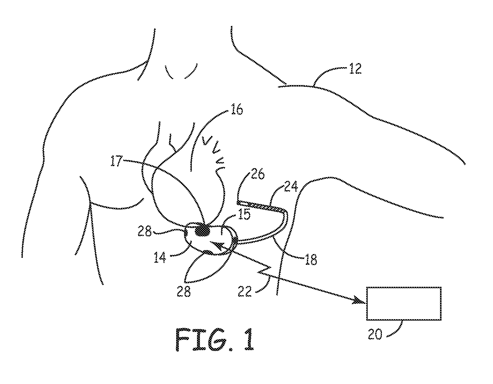 Method and apparatus for verifying a determined cardiac event in a medical device based on detected variation in hemodynamic status