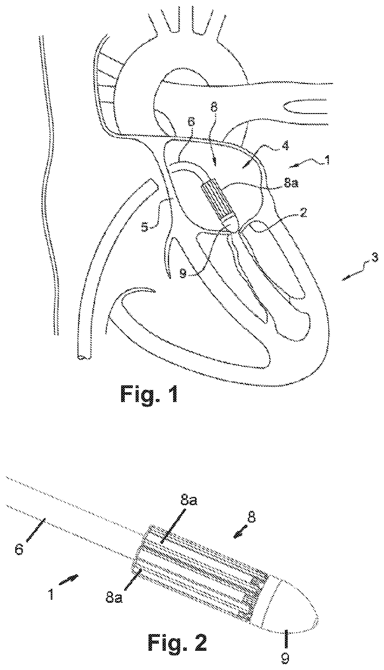 Device for performing or preparing for a mitral valve annuloplasty by a transfemoral approach