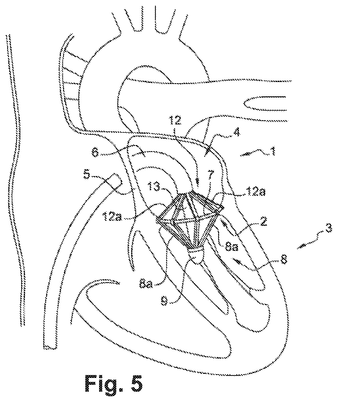 Device for performing or preparing for a mitral valve annuloplasty by a transfemoral approach