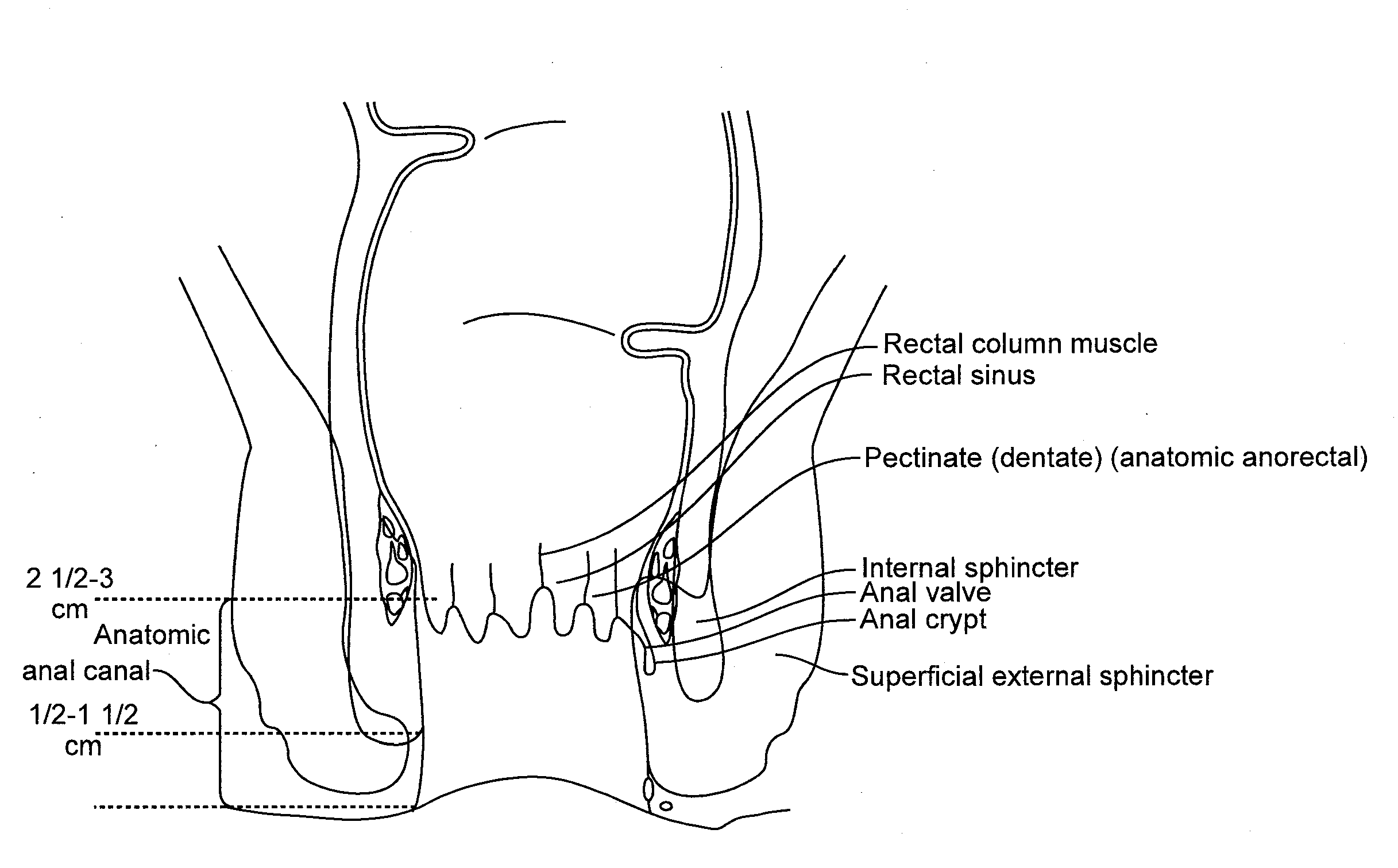 Fecal incontinence device, system and method