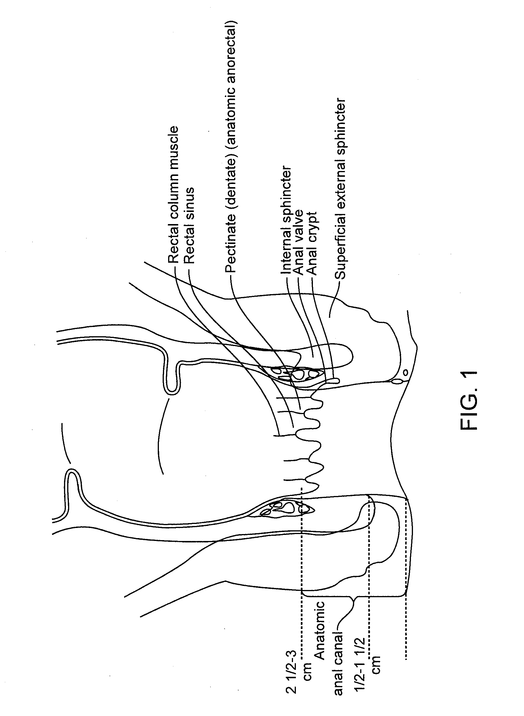 Fecal incontinence device, system and method
