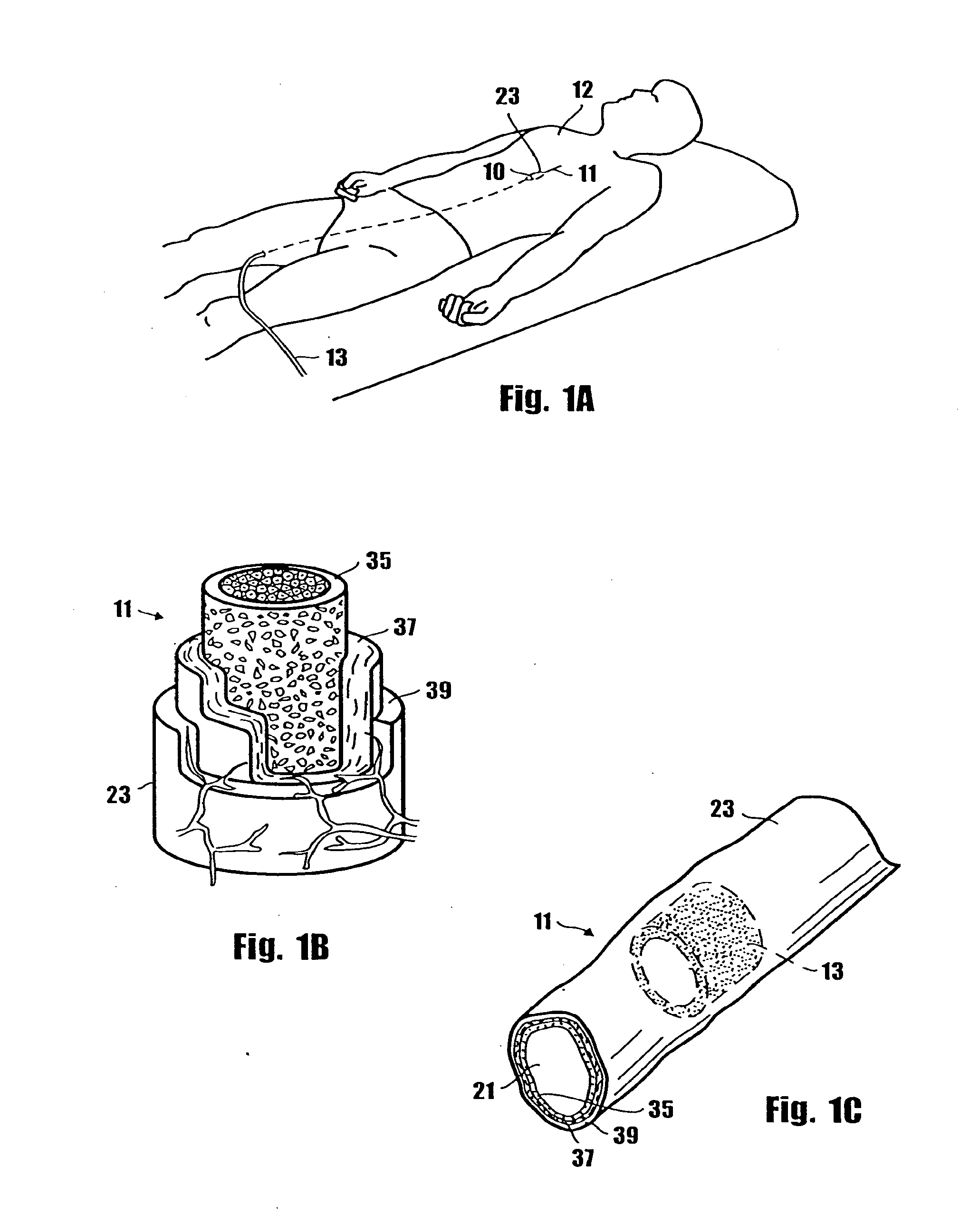 Method for delivering medication into an arterial wall for prevention of restenosis