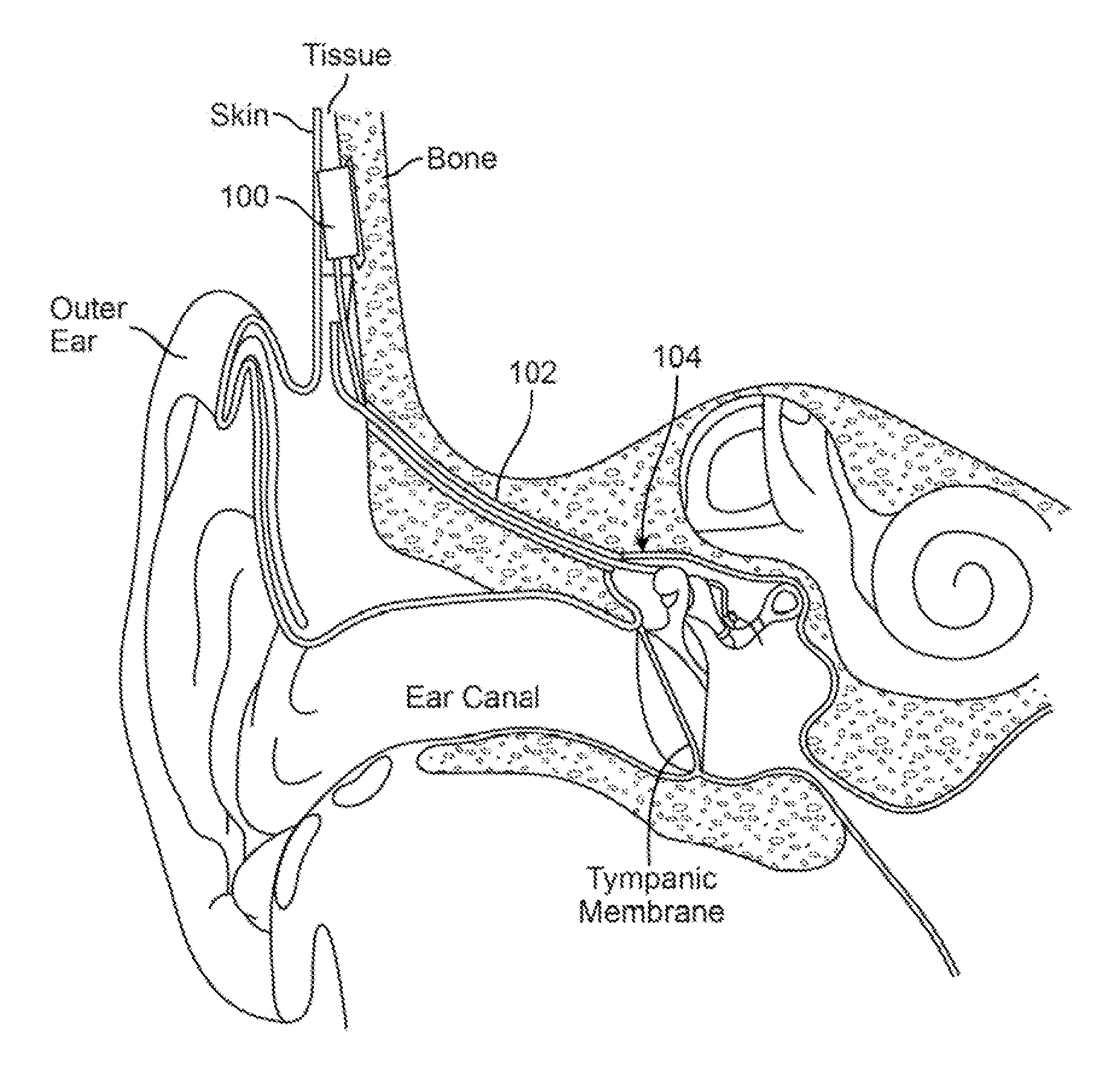 Implantable piezoelectric polymer film microphone