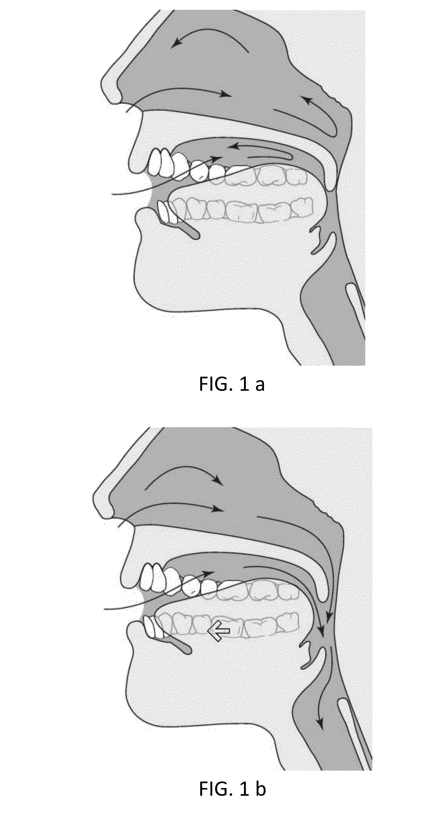 Mandibular repositioning device