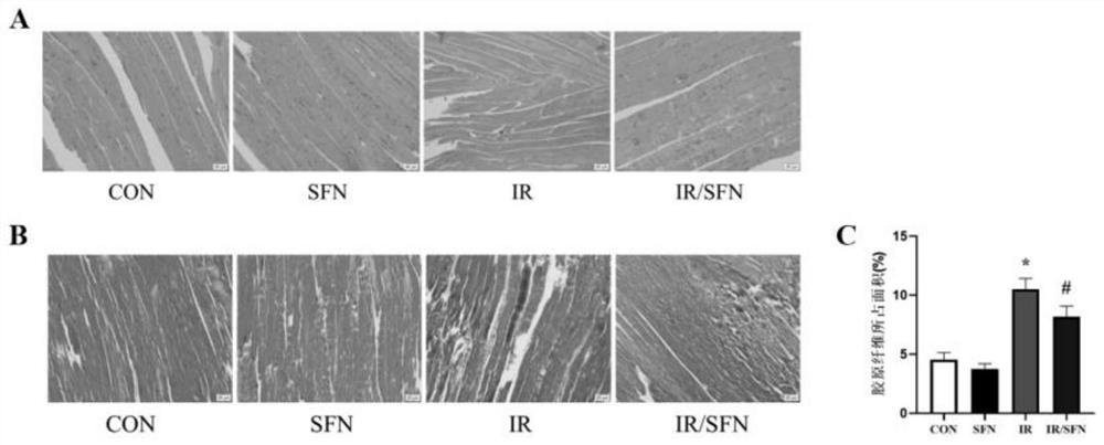 Application of sulforaphane in preparation of drug for inhibiting and/or treating radioactive muscle fibrosis