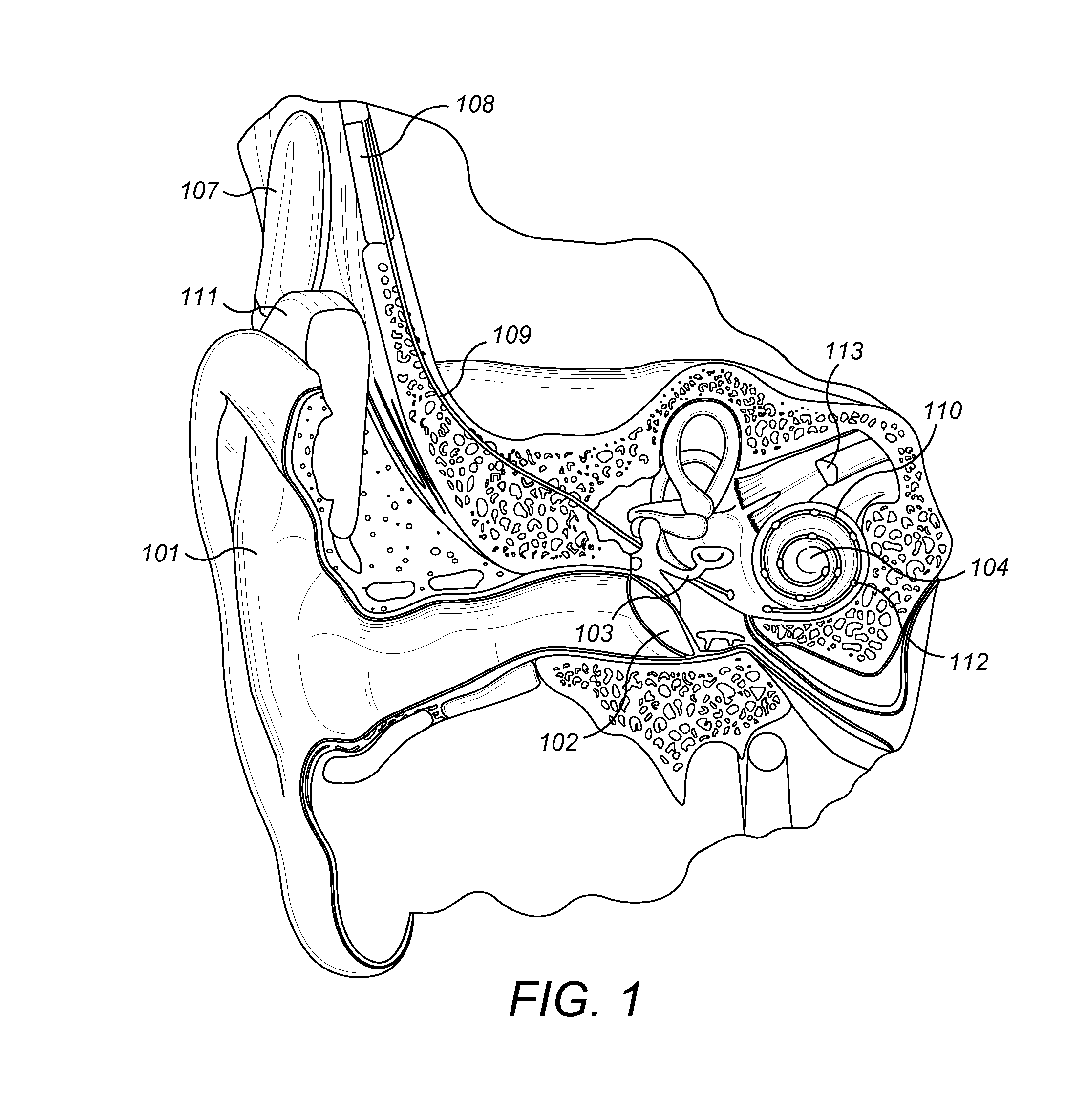 Modified Electrode Lead for Cochlear Implants