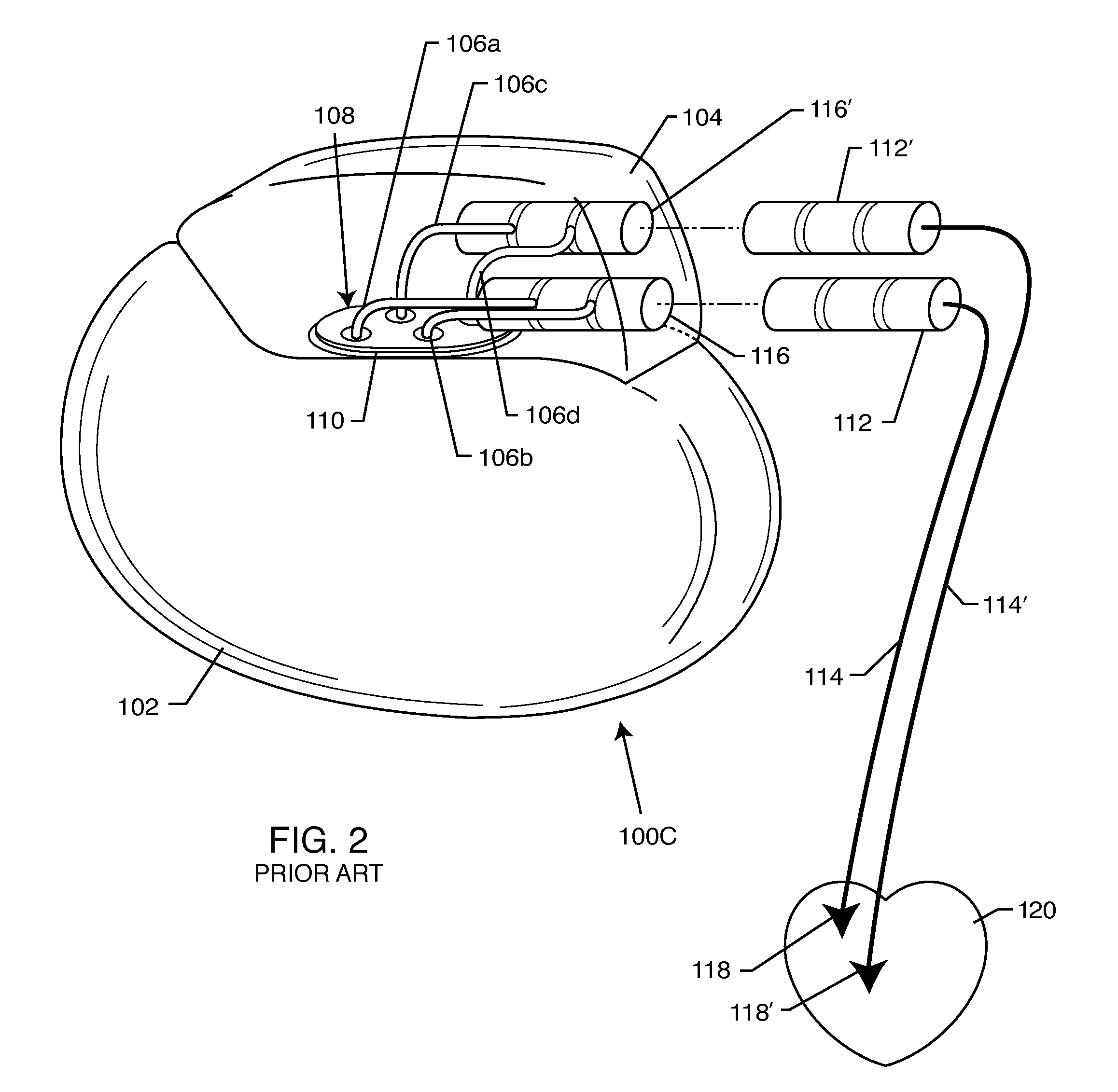 Implantable lead for an active medical device having an inductor design minimizing eddy current losses